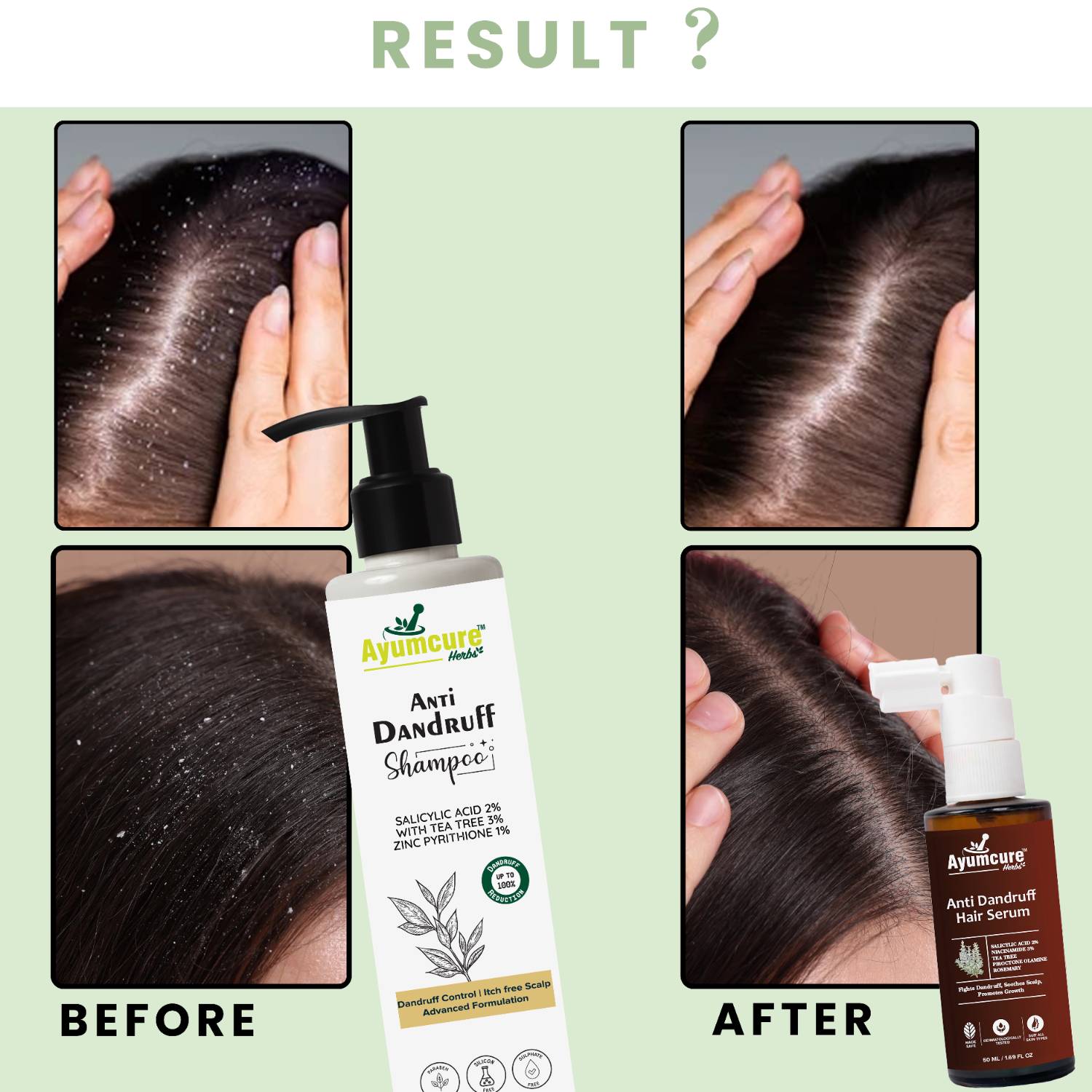 Anti-Dandruff Kit: 3% Tea Tree Shampoo + Niacinamide Serum | Men & Women