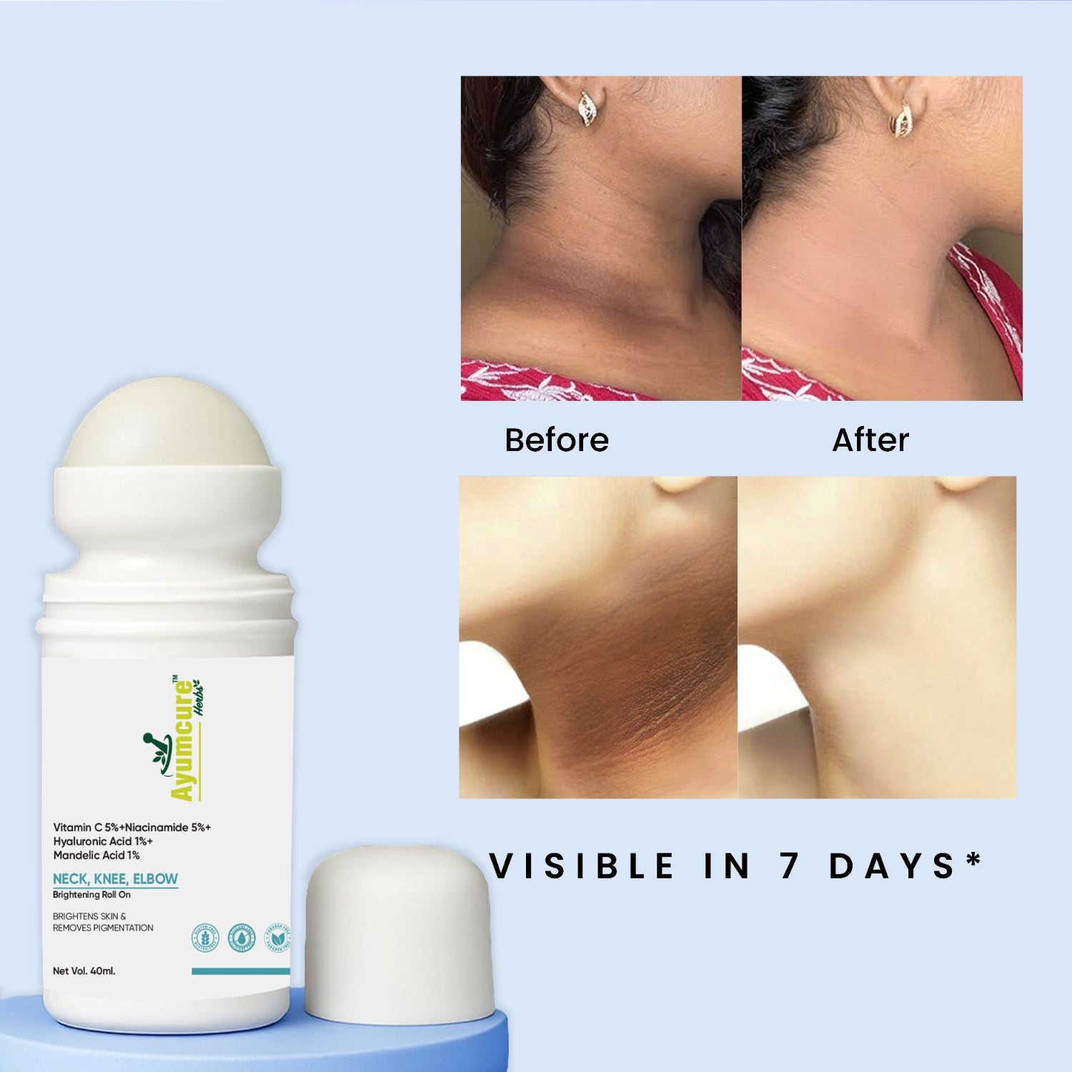 5% Niacinamide Roll-On | Fades Dark Spots on Neck, Knee & Elbow | All Skin Types